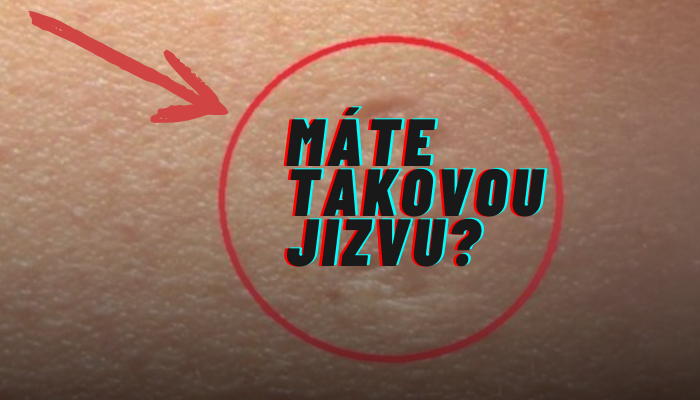 Máte tuto jizvu na rameni? Víte její skutečný význam?