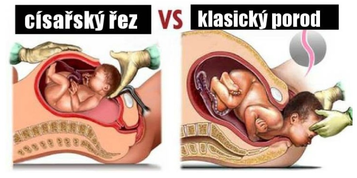 Tohle by si měla přečíst každá žena! Přirozený porod nebo císařský řez? Co je lepší?