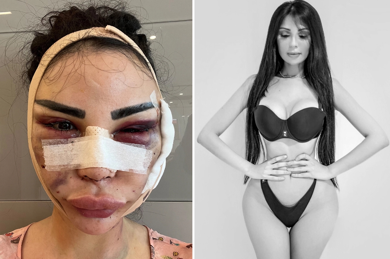 Utratila přes 10 milionů, aby vypadalo jako Kim Kardashian. Nyní toho lituje shání 3 miliony aby vypadala jako předtím..